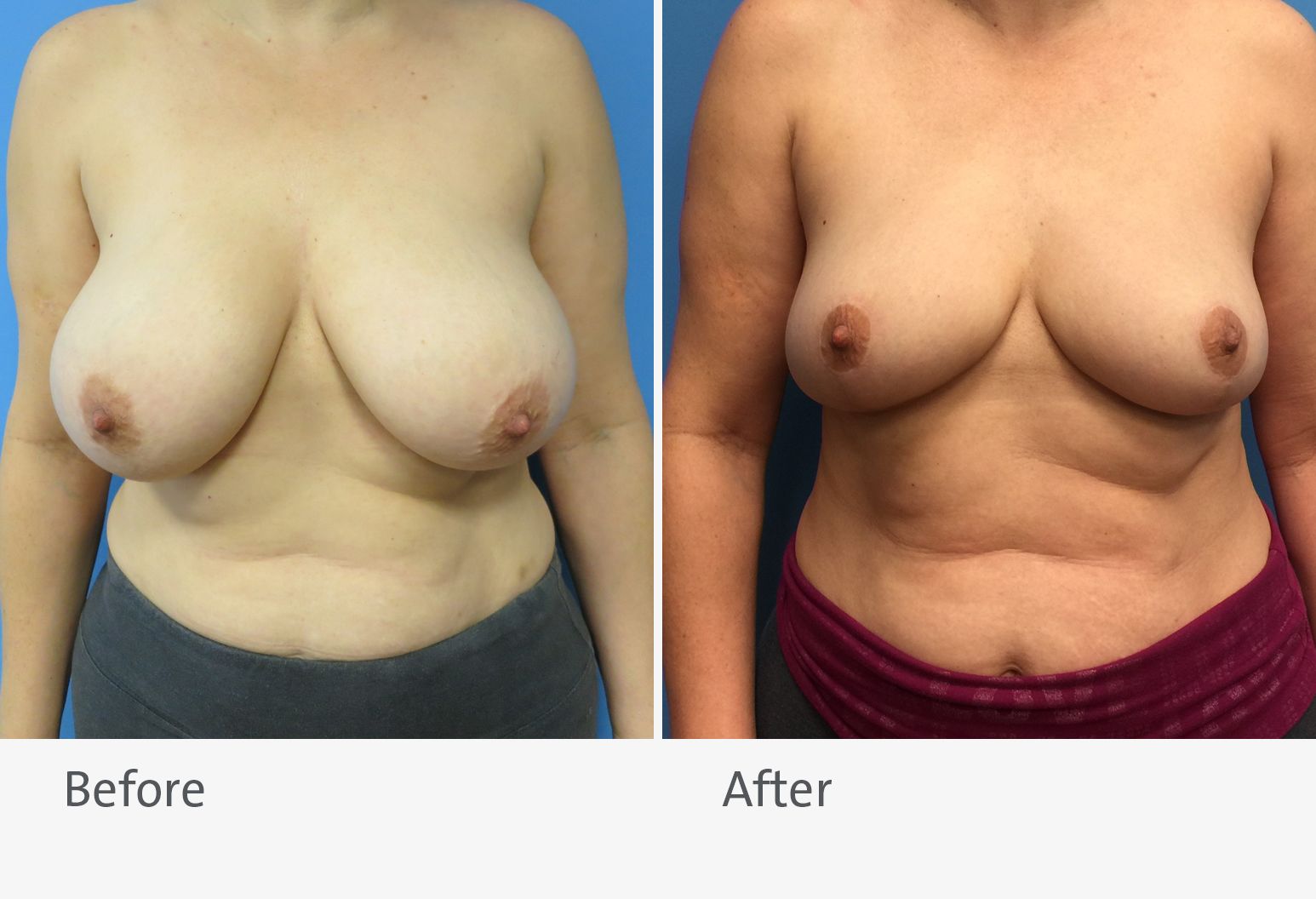 A patient is shown before and after a breast reduction. On the left is the patient before the surgery and on the right is the patient after surgery with slightly smaller breasts.
